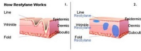 restylane how it works tissue tailored concept